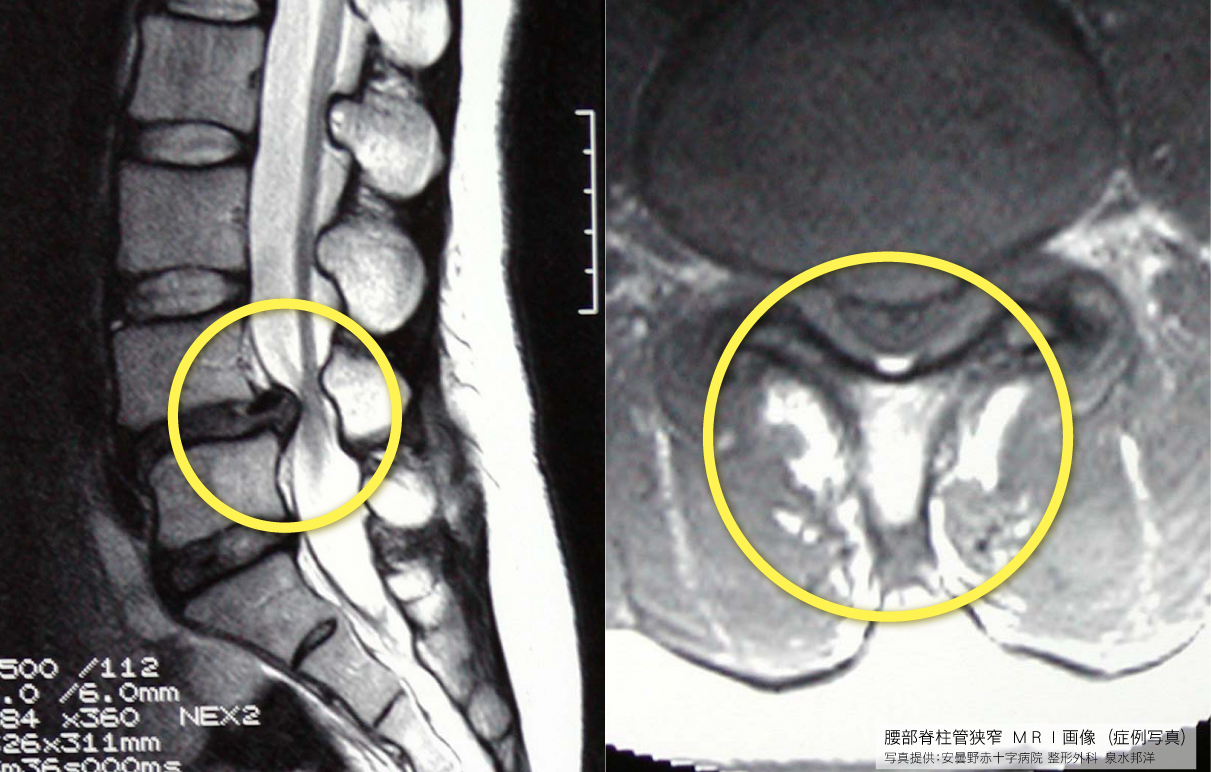 手術なしで改善できるaks療法とは 脊柱管狭窄症専門aks療法